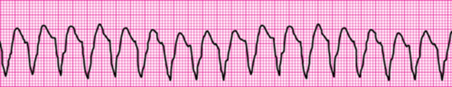 <p>Monomorphic ventricular tachycardia</p>