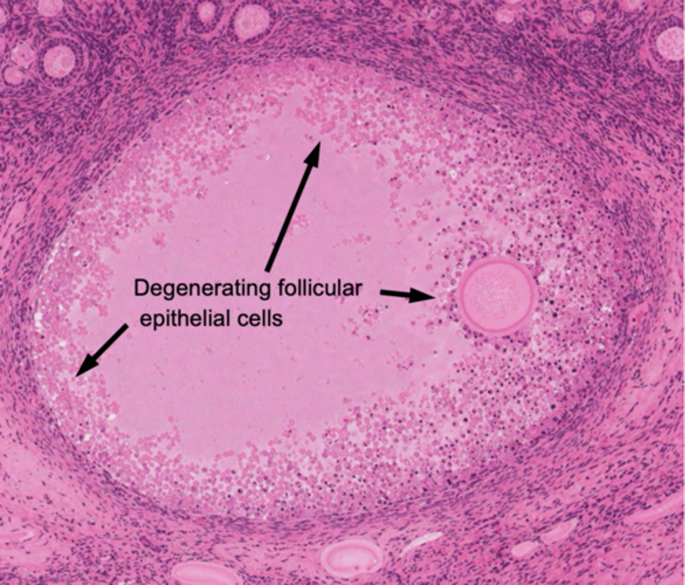 <p>What has the following characteristics:</p><p>- Can occur at any stage of folliculogenesis</p><p>- 98% of follicles will become ________</p><p>- Frequent remnant is the "glassy membrane" (former basement membrane)</p>