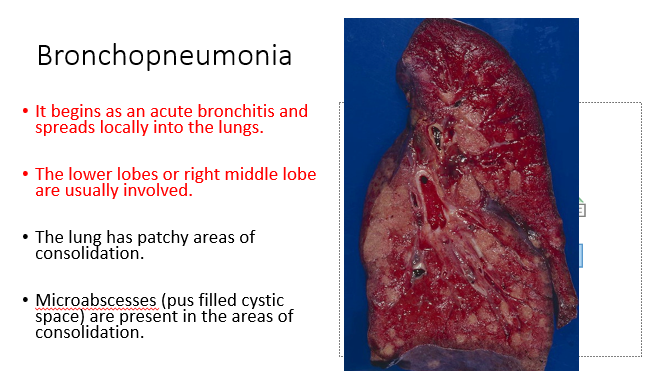 <ul><li><p><span>It begins as an acute bronchitis and spreads locally into the lungs.</span></p></li><li><p><span>The lower lobes or right middle lobe are usually involved.</span></p></li><li><p><span>The lung has patchy areas of consolidation.</span></p></li><li><p><span>Microabscesses (pus filled cystic space) are present in the areas of consolidation.</span></p></li></ul>