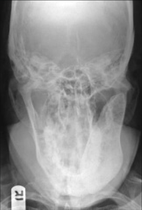 The pt is facing the receptor with mouth open and chin tilted down -30 degrees
