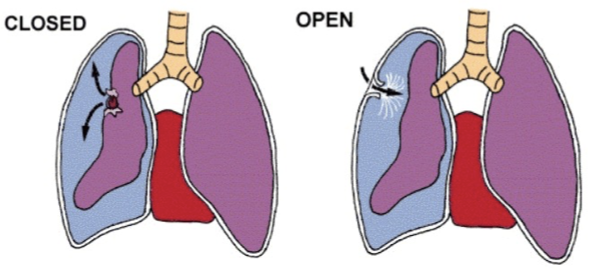 <p><span style="font-family: &quot;Wingdings 2&quot;;"></span><span>The presence of air or gas in the cavity between the&nbsp;lungs&nbsp;and the chest wall, causing collapse of the lung.</span></p><p></p><p><span style="font-family: &quot;Wingdings 2&quot;;"></span><span>Open: from trauma/injury</span></p><p><span style="font-family: &quot;Wingdings 2&quot;;"></span><span>Closed: spontaneous</span></p><p></p><p><span style="font-family: &quot;Wingdings 2&quot;;"></span><span>Note: BIG factor is the Degree of collapse and nature of collapse</span></p>