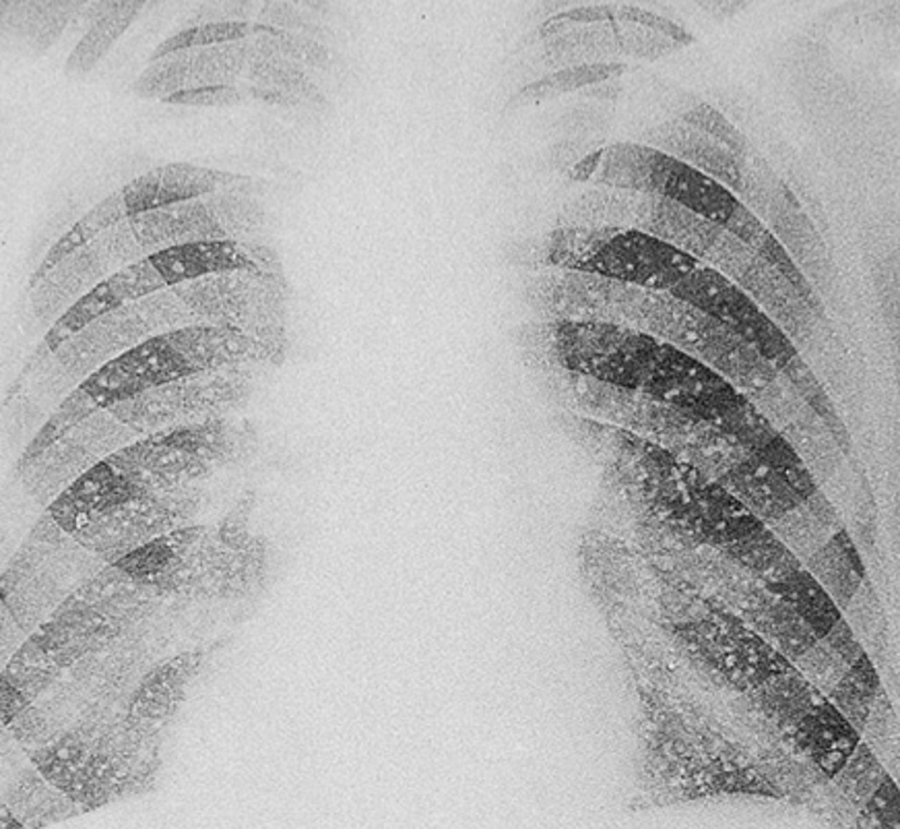 <p>fungal infection of the lungs</p>