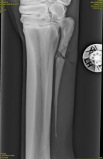 <p>AKP store husdyr blok 4 2024</p><p>Du tilser en hest med et sår på piben efter et spark og beslutter dig for at tage røntgenbilleder. Du ser derved nedenstående læsion. Hvad er hestens prognosis quo ad tempus?</p><p>1 Såfremt tilstanden ikke kompliceres (af eks. gaffelbåndsskade), vil hesten kunne påbegynde træning 4 uger efter operation </p><p>2 Såfremt tilstanden ikke kompliceres (af eks. gaffelbåndsskade), vil hesten kunne påbegynde træning 8 uger efter operation </p><p>3 Sårfremt tilstanden ikke kompliceres (af eks. gaffelbåndsskade), vil hesten kunne påbegynde træning 12 uger efter operation </p><p>4 Hesten vil med stor sandsynlighed ikke komme tilbage i ridning</p>