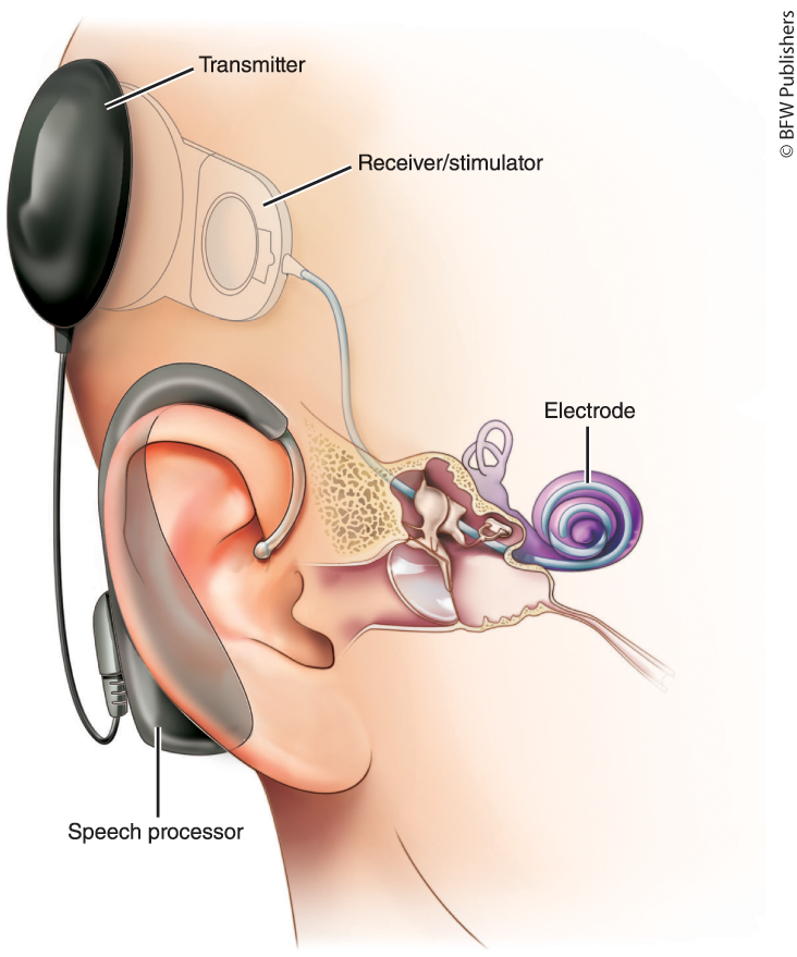 <p>device for <u>converting sounds into electrical signals</u> + <u>stimulating the auditory nerve through electrodes threaded into the cochlea</u></p>