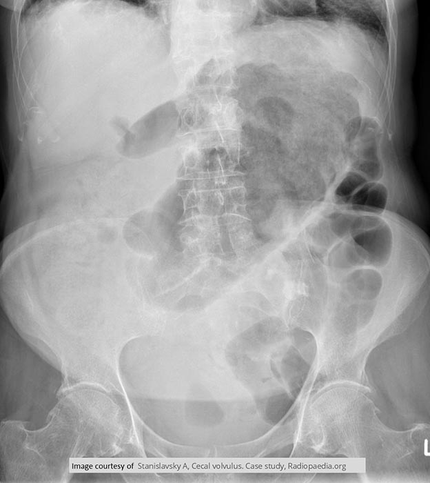 <p>In the cecum and sigmoid colon. (image shows cecal volvulvus)</p>