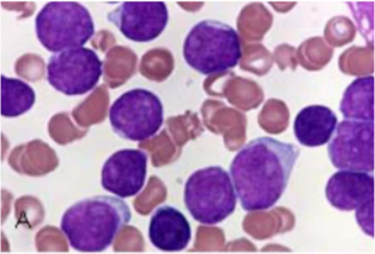 <p>-no auer rods, positive staining for TdT</p>