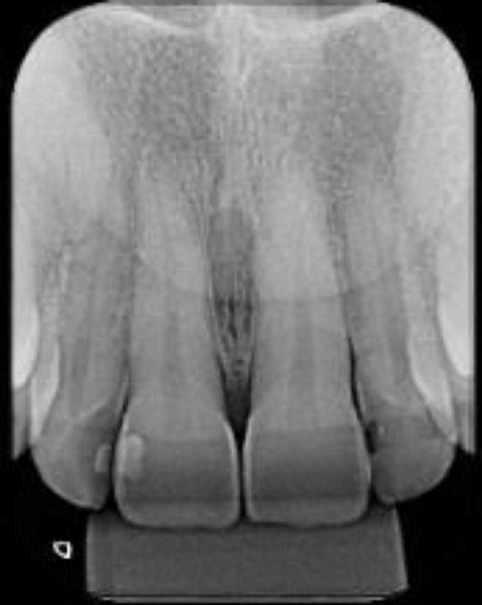 <p>ID the apical diagnosis:</p><p>- Palpation: Non-tender/0</p><p>- Percussion: Non-tender/0</p><p>- Swelling: no</p><p>- Sinus Tract: no</p><p>- Pain: no</p><p>- Periapical Radiolucency: no</p><p>- The lamina dura surrounding the root is intact and the periodontal ligament space is uniform.</p>
