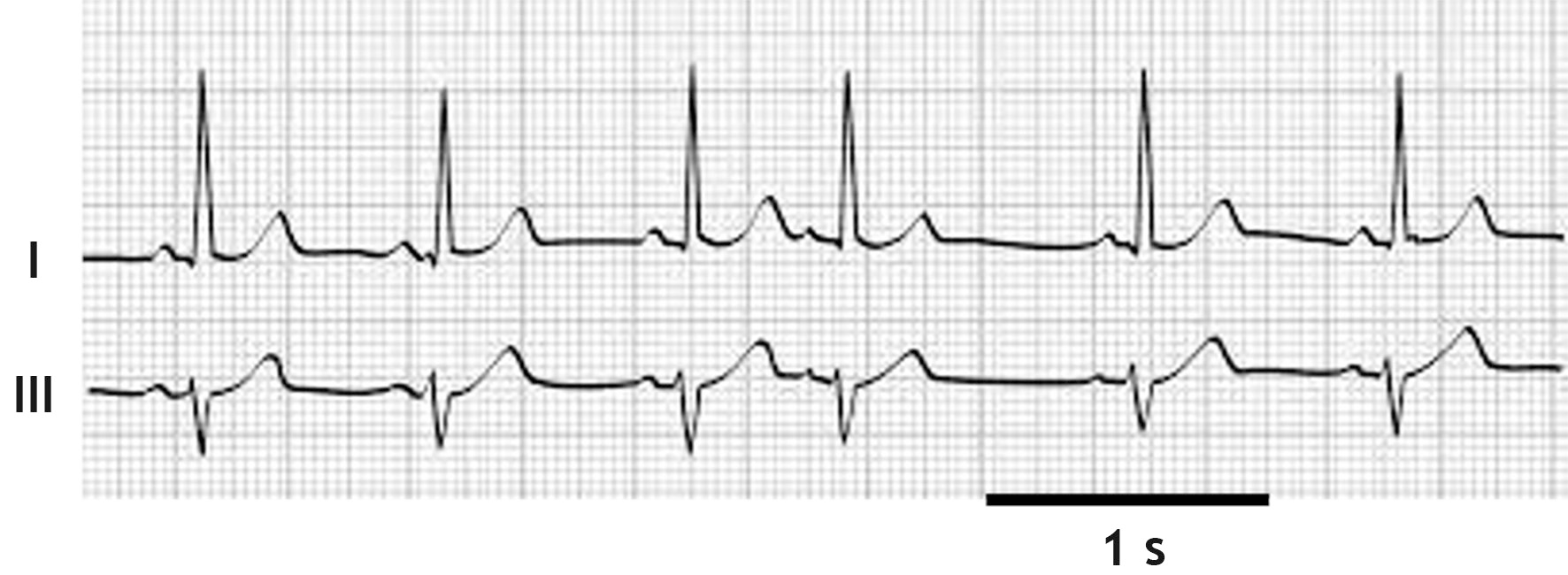 <p>34. During a routine examination of a young man, an ECG is recorded. The diagram shows the Einthoven leads I and III of the ECG.</p><p>Which conclusion can most likely be drawn from the ECG?</p><p>The ECG shows a:</p><p>A. Second-degree AV block</p><p>B. Third-degree AV block</p><p>C. Bradycardia</p><p>D. Supraventricular extrasystole</p><p>E. Ventricular extrasystole</p>