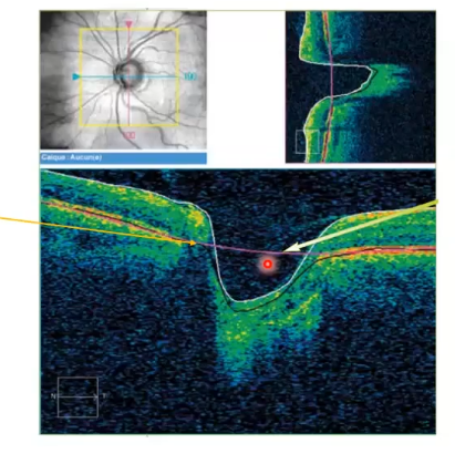 <p>(1) /; otpic disc cube; onh topography analysis</p>