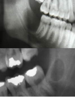 <p>Is a primordial cyst common?</p>