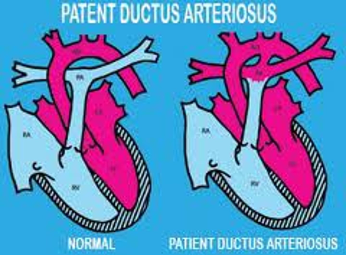 <p>fetal shunt fails to close at birth</p><p>- high risk if premature</p><p>- O2 blood overflows lungs</p><p>- leads to CHF if large</p>