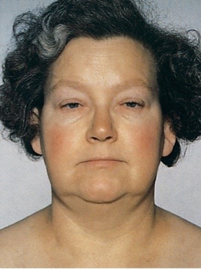<p>severe form of hypothyroidism</p>