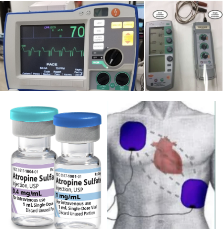 <p><strong>Treatment:</strong></p><ul><li><p class="">Fix the problem/correct the cause.</p></li><li><p class="">Stop the meds, warm the patient, and stop nausea/vomiting.</p></li></ul><p class=""><strong>If Symptomatic:</strong></p><ol><li><p class=""><strong><em><mark data-color="yellow" style="background-color: yellow; color: inherit"><u>Atropine 1 mg IV bolus, repeated every 3 to 5 minutes until a maximum dose of 3 mg.</u></mark></em></strong></p><ul><li><p class="">An order is typically needed, except for emergencies; Have to be ACLS trained.</p></li><li><p class=""><strong>How do you know when to stop giving the atropine?</strong>—You have reached your max dose or you patient is now stable (Pulses, HR, BP, etc.)</p></li></ul></li><li><p class="">If ineffective, apply pacing pads to the skin for transcutaneous pacing. (a little more invasive)</p><ul><li><p class="">Provide medication/sedation prior—it shocks!</p></li></ul></li><li><p class="">If that is ineffective, administer epinephrine and/or dopamine.</p></li></ol><p></p>