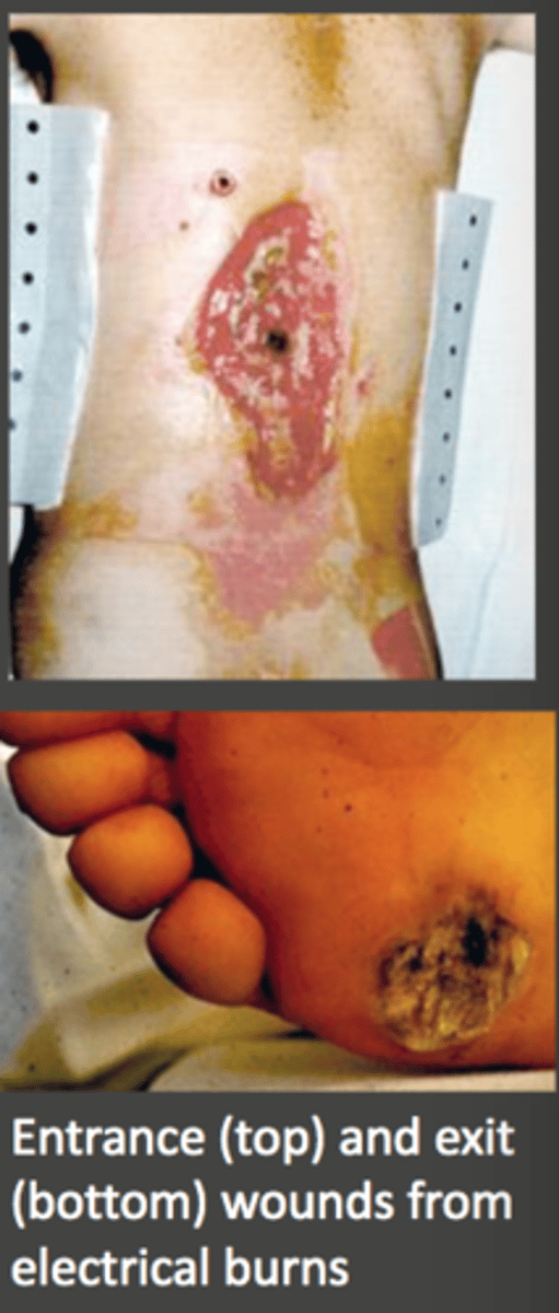 <p>- exit wound treatment &amp; address electrical abnormalities within the pts body to tx eg:</p><p>- arrhythmia tx (eg. Vfib) or seizure tx (put pt on an ECG)</p>