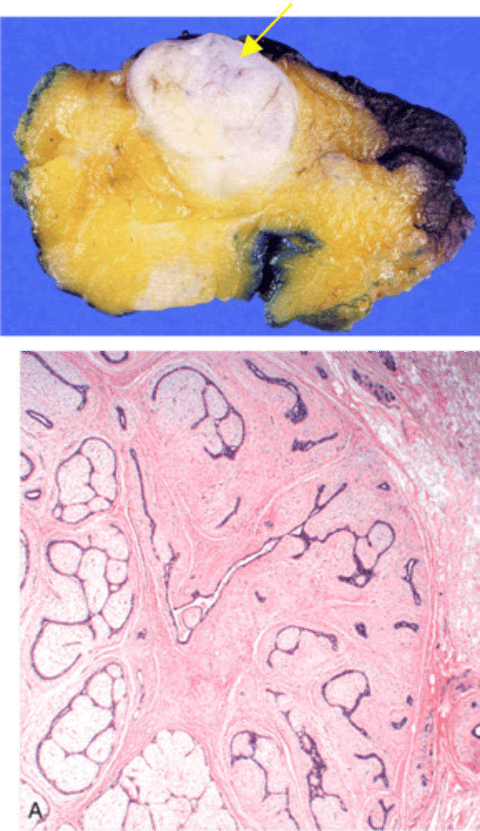 <p>Define Condition:</p><p>MC BENIGN Neoplasma of Breast - Tumor of fibrous tissue and glands (fibroepithelial tumor)</p><p>-Hx: Premenopausal Women</p><p>-Sx/PE: </p><p>&gt; Well-circumscribed, mobile marble-like mass</p><p>&gt; May grow during pregnancy &amp; cause pain during menstrual cycle (estrogen sensitive)</p><p>-Dx:</p><p>&gt; Gross = well-circumscribed tan white nodule</p><p>&gt; Histo = Biphasic tumor with compressed epithelial lined spaces and uniform stromal cells that have low stromal cellularity</p>