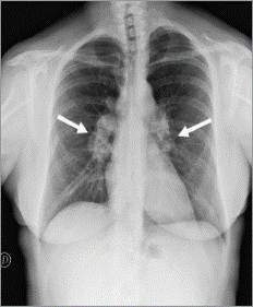 <p>Sarcoidosis (type of granulomatous disease)</p>