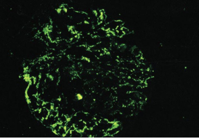 <p>An 8 year old boy is brought to the office due to acute facial puffiness. His mother reports that he has been fatigued and has had dark urine. The patient was treated for a skin infection 3 weeks ago but has no chronic medical conditions. Temperature is 97 F, BP is 140/94. PE shows periorbital edema and mild pitting edema along the ankles. Renal biopsy was performed and the sample is shown below.</p><p>The fluorescent areas on the slide most likely indicate the presence of which of the following substances? </p>