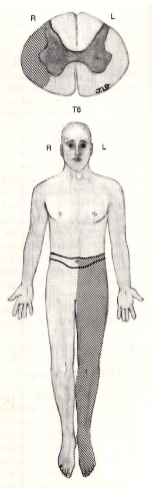 <p>(spinothalamic)</p><p>deficit in pain/temperature on opposite side of body at the level of lesion and below</p>