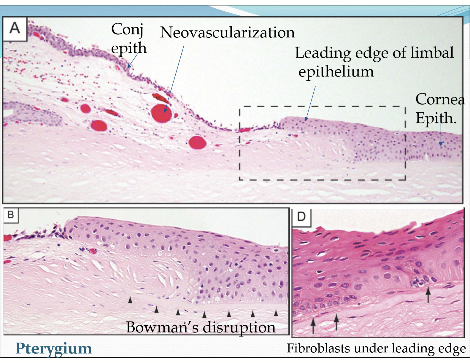 <ul><li><p>Mutation of limbal stem/epithelial cells causing them to inappropriately proliferate into conj cells</p></li><li><p>Destruction of limbal stem/epithelial cells which normally act as a physical barrier to conj proliferation and encroachment into the cornea </p></li></ul><p></p>