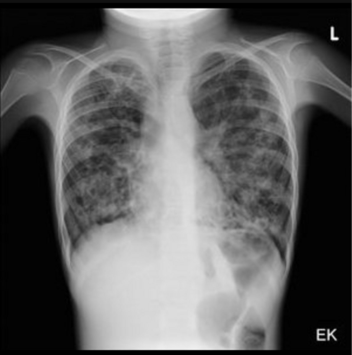 <p>Child presents with recurrent pulmonary infections, hemoptysis, poor weight gain, steatorrhea, copious amounts of sputum, frequent blood-stained and containing mucus plugs</p>