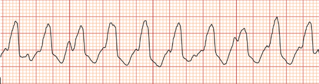 <p>The QRS Complex is irregular, and increased R complexes</p>