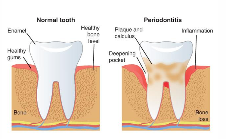 <ul><li><p><span>Chronic inflammatory disease of supportive tissue of the teeth</span></p></li><li><p><span>Characterized by red, swollen, bleeding gums, teeth with exposed tooth surfaces, and bone loss</span></p></li></ul><p></p>