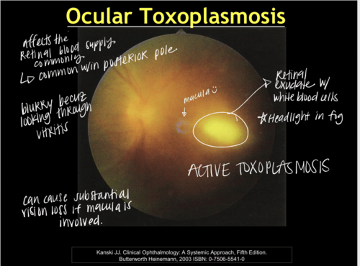 <p>Ocular Toxoplasmosis (Pic)</p>