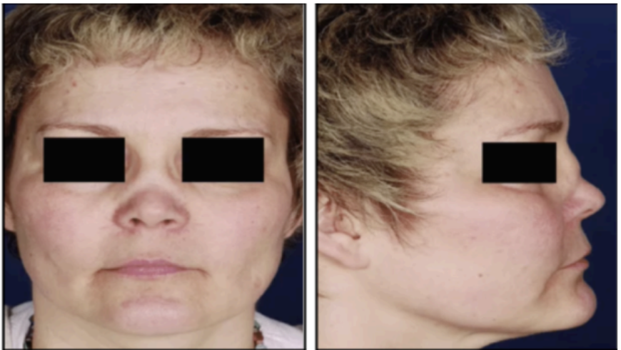 <p>Presence of hematoma between the septal cartilage and perichondrium causes a result in destruction of septum, resulting in this deformity</p>