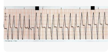 <p>What ECG rhythm is this? Is it shockable?</p>