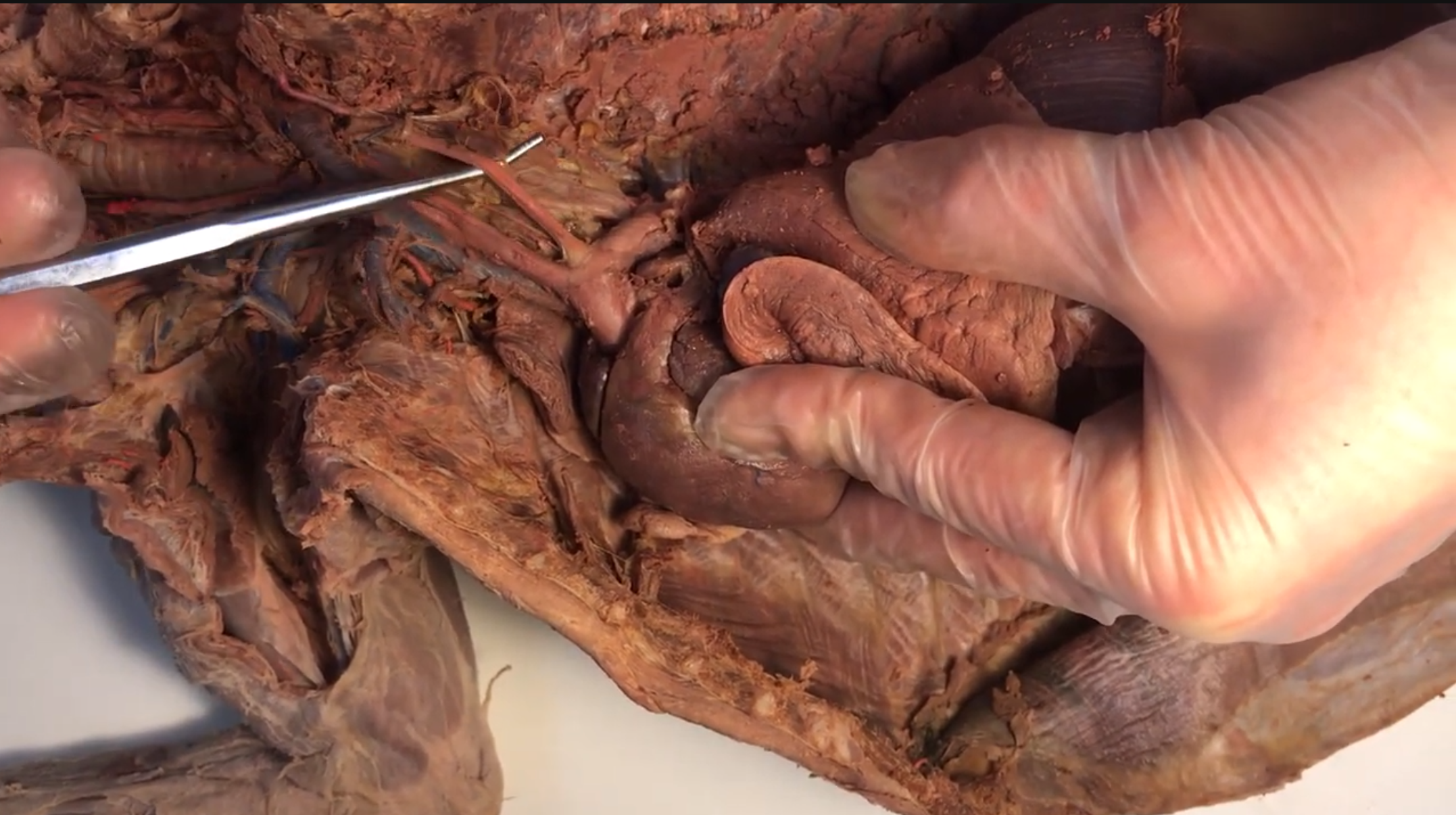 <p>What artery is this</p>