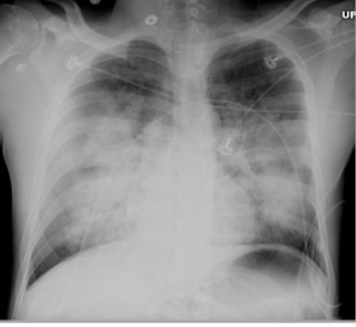 <p>Pulmonary edema</p>