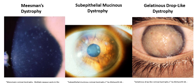 <p>Meesman’s Dystrophy</p><p>Subepithelial Mucinous Dystrophy</p><p>Gelatinous Drop-like Dystrophy</p>