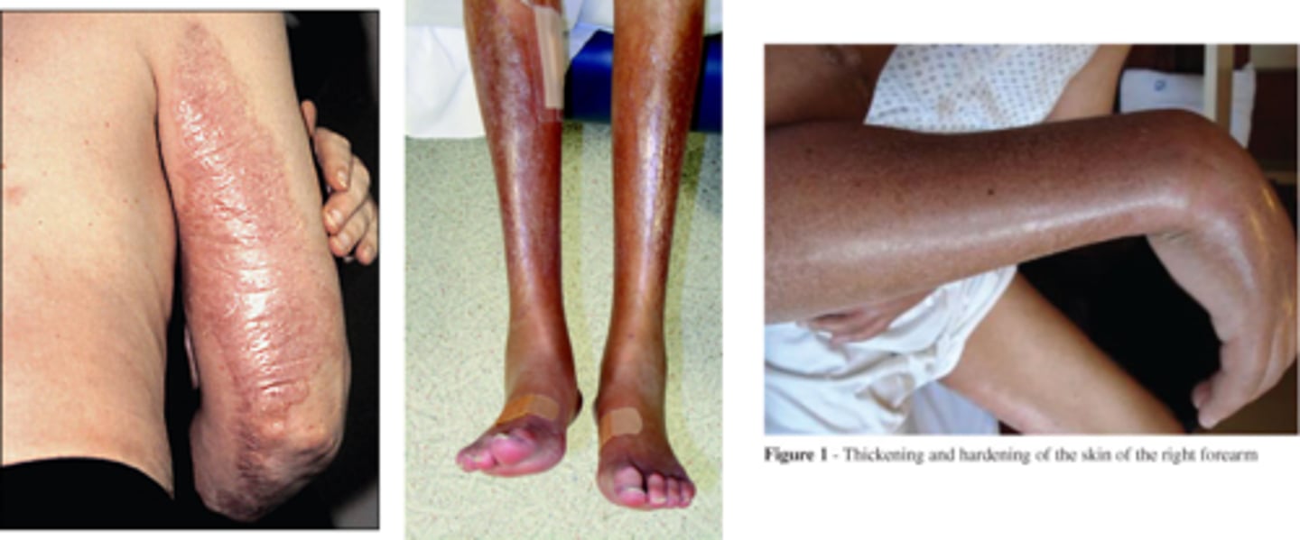 <p>Risk of receiving MRI contrast</p><p>-Pt develops large areas of indurated skin with fibrotic nodules &amp; plaques (similar to scleroderma)</p><p>-Gadolinium found in tissue samples (can be deposited in almost any tissue in the body)</p>