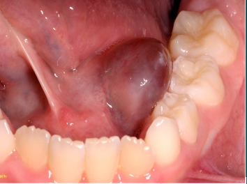 <p>What triggers the size increase of a ranula?</p>