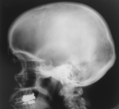 <p>What is this X-ray demonstrating?</p>