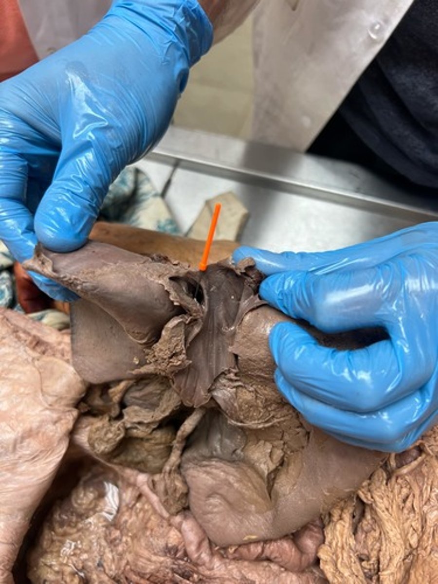 <p>l-r hepatic vain</p>