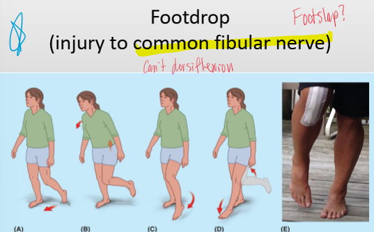 <p>Injury to the common fibular nerve  because <strong><em>it </em></strong>innervates the ankle and toe extensors</p>