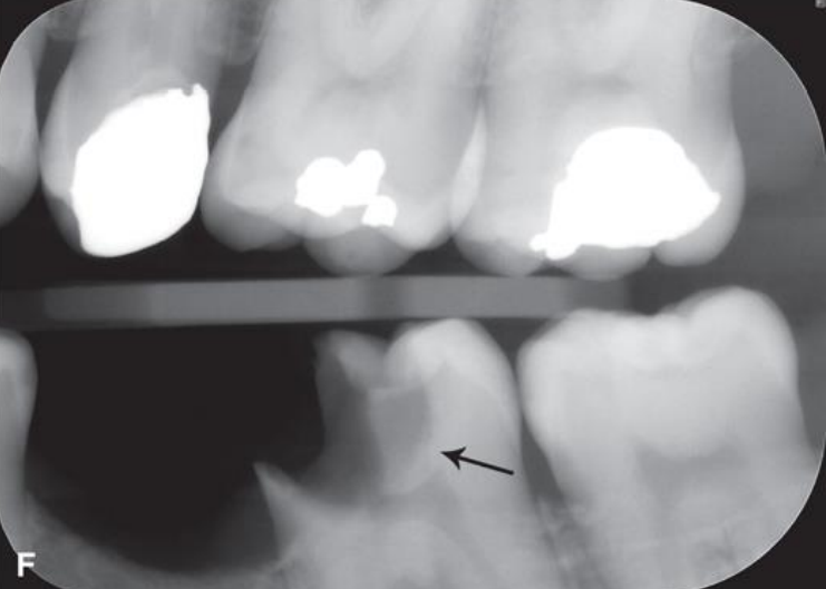 <p>classify this lesion according to the ADA and ICDAS/ICCMS systems </p>
