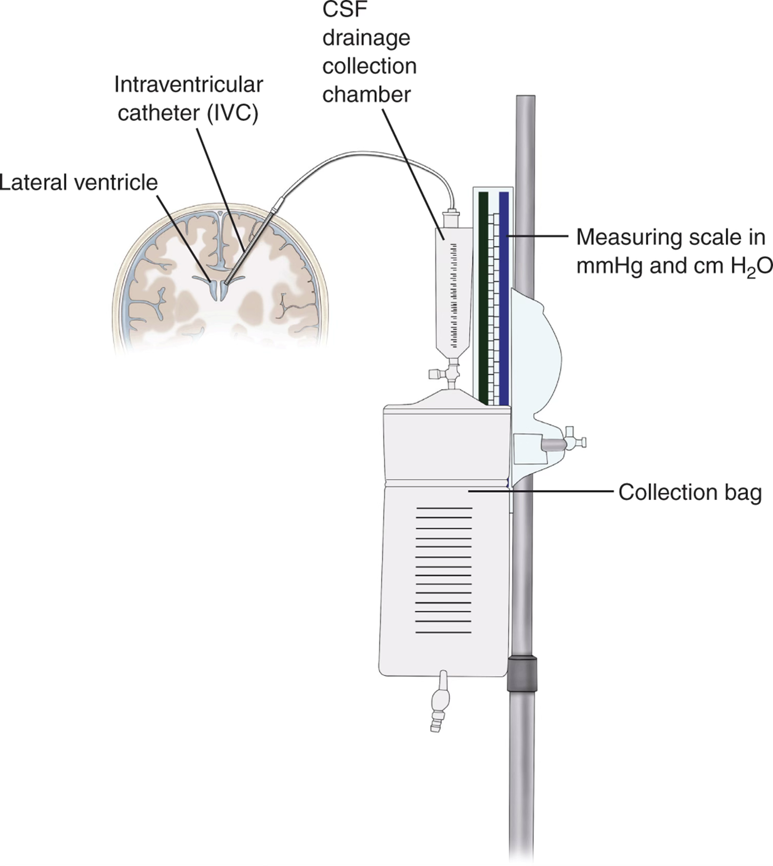 <p><span>Keep dressing over catheter dry and change as prescribed</span></p><p><span>Monitor insertion site for CSF leakage, drainage or infection</span></p><p><span>​Maintain proper device height</span></p><p><span>Monitor for manifestations of infection</span></p><p><span>Use strict aseptic technique when</span></p>