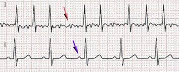 <p>Chaotic pattern w/ no P waves</p>