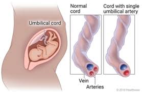 <p>Single Umbilical Artery (SUA)</p>