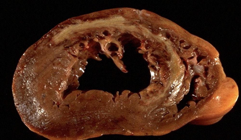 <p>Severe disorder with rapid, aggressive onset; usually self-limiting and presents clear signs and symptoms (e.g., <strong>acute myocardial infarct</strong>).</p>