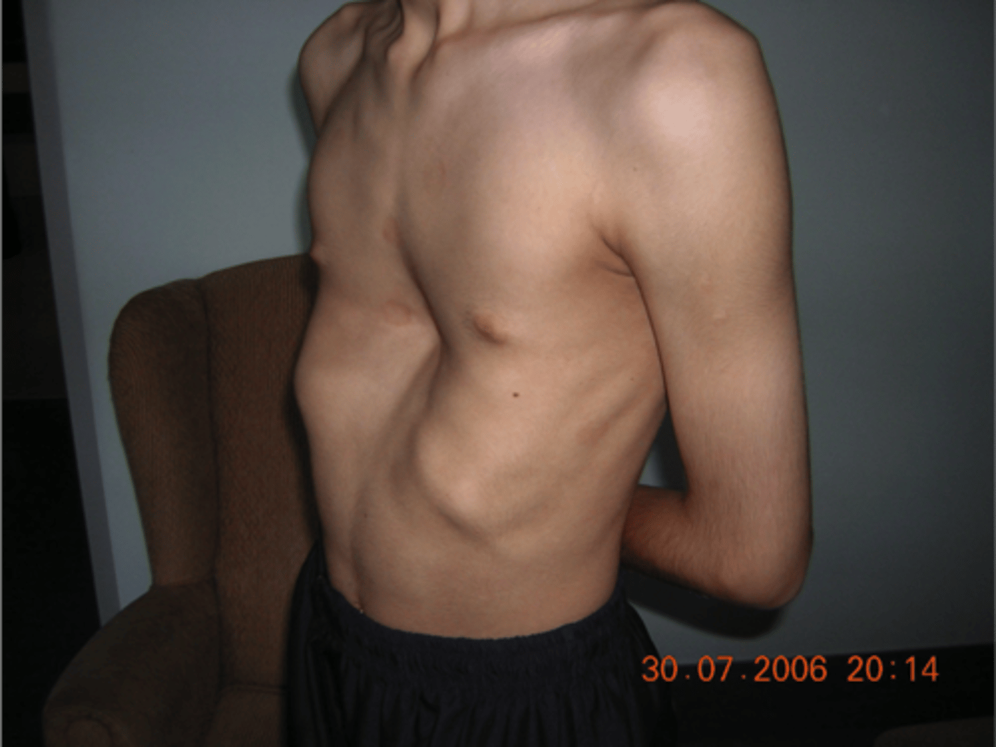 <p>-sunken sternum</p><p>-occurs at birth</p><p>*think excavate=dig a hole</p>
