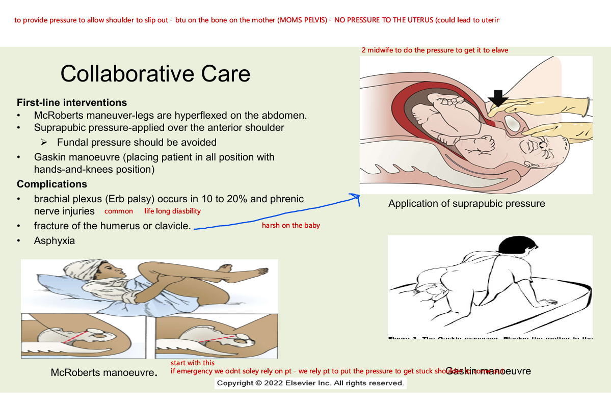 <ul><li><p>first line interventions</p><ul><li><p>mc roberts maneuver - legs hyperflexed on the abdomen</p></li><li><p>suprapubic pressure applied over the anterior shoulder</p><ul><li><p>fundal pressure should be avoided</p></li></ul></li><li><p>gasking manoeuvre (placing patient in all position with hands and knees position)</p></li></ul></li><li><p>complications</p><ul><li><p>brachial plexus (erb palsy) occurs in 10-20%  and phrenic nerve injuries</p></li><li><p>fracture of the humerus or clavicle</p></li><li><p>asphyxia </p></li></ul></li></ul><p></p>