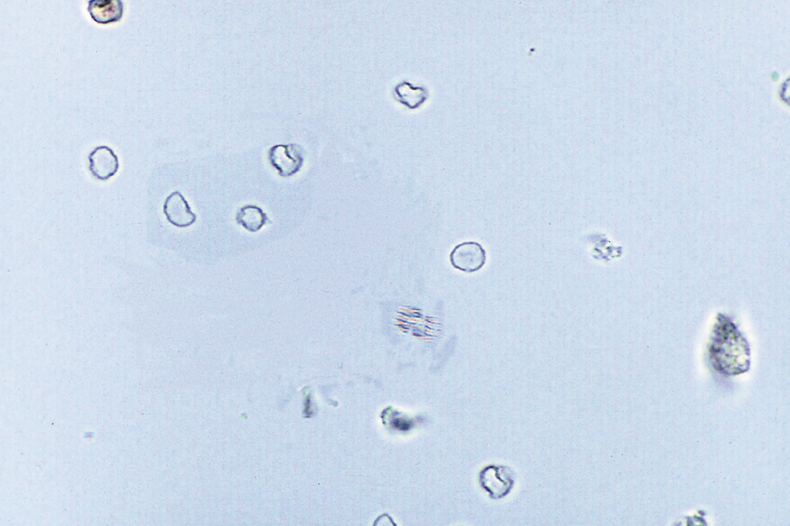 <p>RBCs that exhibit varying size (<span style="color: red;">anisocytosis</span>) and shape (<span style="color: red;">poikilocytosis</span>)</p><ul><li><p>Primarily associated with glomerular bleeding = acanthocytes</p></li><li><p>Strenous exercise</p></li></ul><p></p>