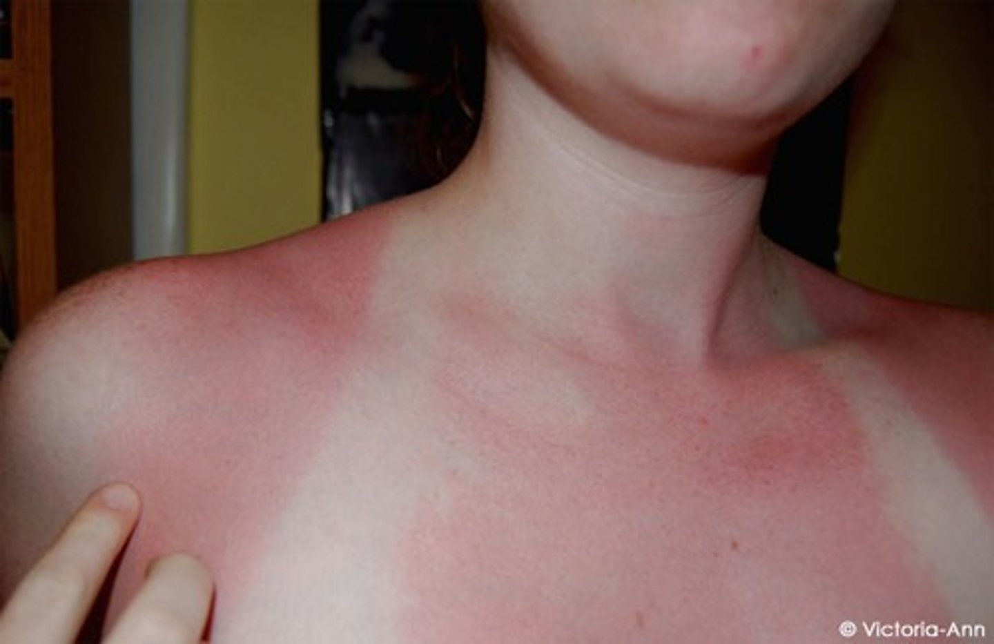 <p>what type of burn is this describing?</p><p>red painful skin without blistering</p><p>only epidermis</p>