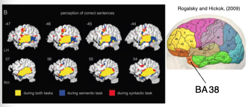 <p class=""><strong>Selective attention</strong> targets the <strong>Anterior Temporal Lobe</strong></p><ul><li><p class="">Focuses on language processing and meaning</p></li></ul><p></p><p class=""><strong>Violations:</strong></p><ul><li><p class=""><strong>Syntactic violation:</strong> <em>"A tailor in the city were altering the gown."</em></p><ul><li><p class="">Triggers <strong>syntactic reanalysis</strong> → often associated with ERP markers like <strong>P600</strong>.</p></li></ul></li><li><p class=""><strong>Semantic violation:</strong> <em>"That coffee at the diner was pouring the waiter."</em></p><ul><li><p class="">Triggers <strong>semantic integration failure</strong> → often linked to <strong>N400</strong> response.</p></li></ul></li></ul><p></p><p class=""><strong>Brain Activation:</strong></p><ul><li><p class=""><strong>BA 38 (Brodmann Area 38)</strong></p><ul><li><p class="">Activated during <strong>semantic and syntactic processing</strong></p></li><li><p class="">Color-coded:</p><ul><li><p class="">Yellow = Both tasks</p></li><li><p class="">Blue = Semantic</p></li><li><p class="">Red = Syntactic</p></li></ul></li></ul></li></ul><p></p><p><span data-name="brain" data-type="emoji">🧠</span> <strong>What does BA 38 do in these cases?</strong> </p><ul><li><p>It’s <strong>activated in both types of violations</strong>.</p></li><li><p>Suggests it plays a role in <strong>integrating meaning and structure</strong> — not just isolated semantic or syntactic processing.</p></li><li><p><strong>Selective attention</strong> may amplify ATL activity when the brain tries to resolve conflicts or detect anomalies in meaning or grammar.</p></li></ul><p></p>
