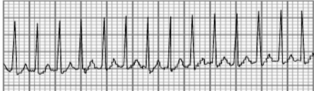 <p>Supraventricular Tachycardia </p>