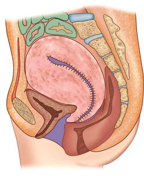 <p>when th euterus remianes enlarged with contiuned lochial discharge and can result i postpartum hemorrhage </p>