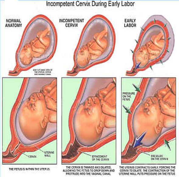 <ul><li><p>Painless dilation of the cervix without labor or uterine contractions.</p></li><li><p><strong>Contributing Factors</strong>:</p><ul><li><p>Congenital</p></li><li><p>Acquired</p></li><li><p>Biochemical</p></li></ul></li></ul><p></p>